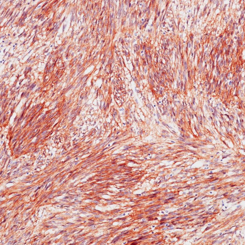 Gastrointestinal stromal tumor