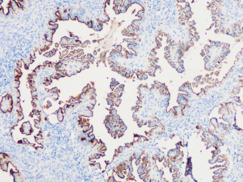 Ovarian cancer