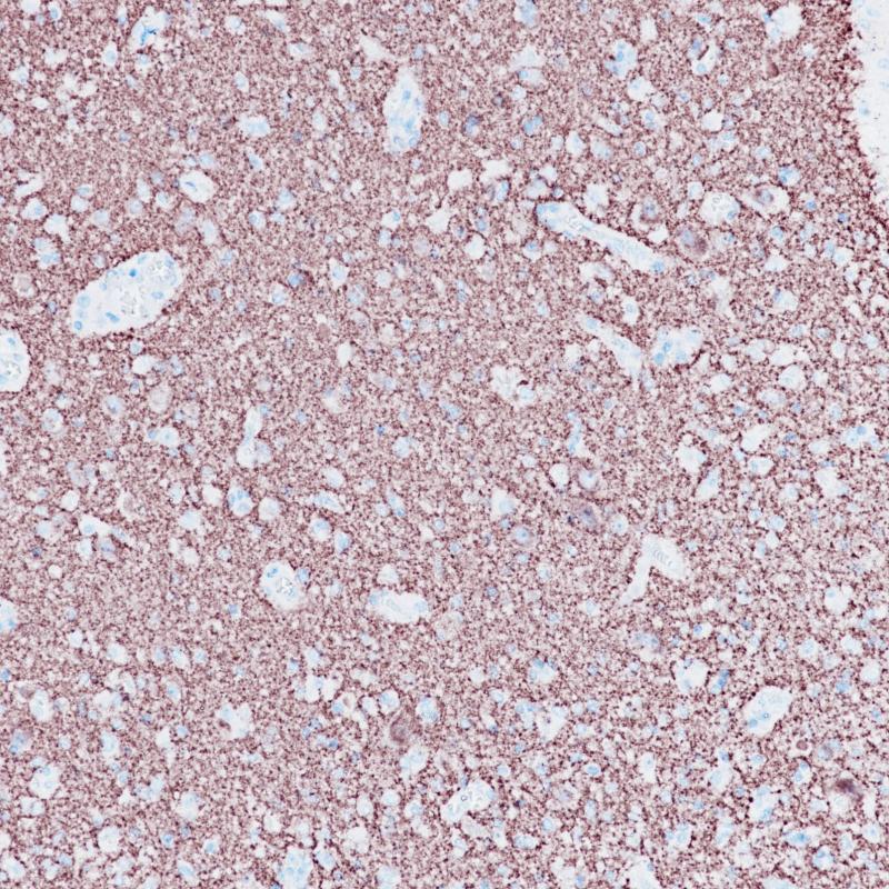 Glioma