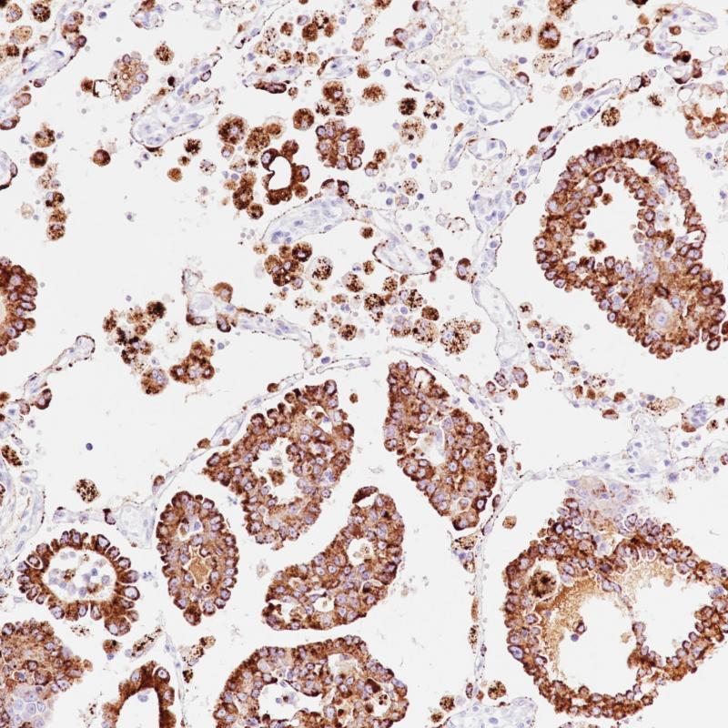 Lung adenocarcinoma