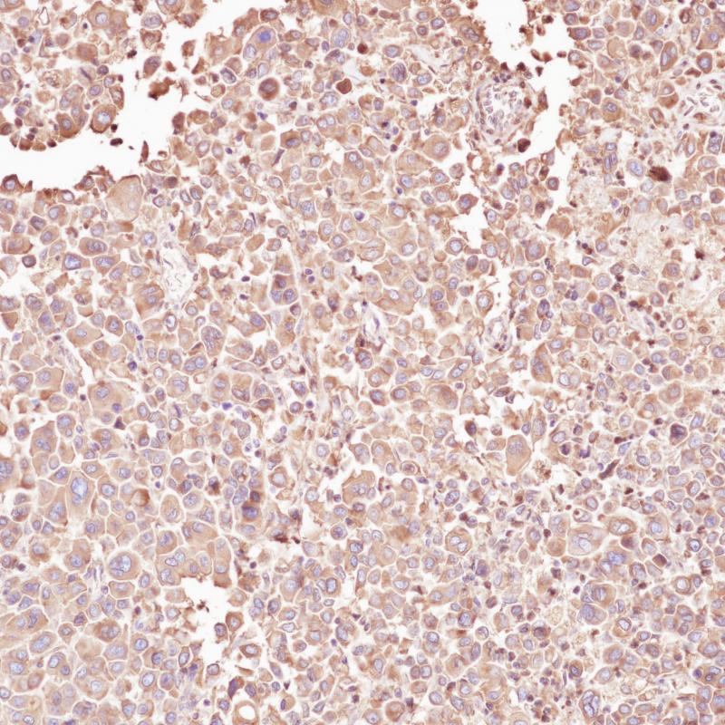 Gastric cancer