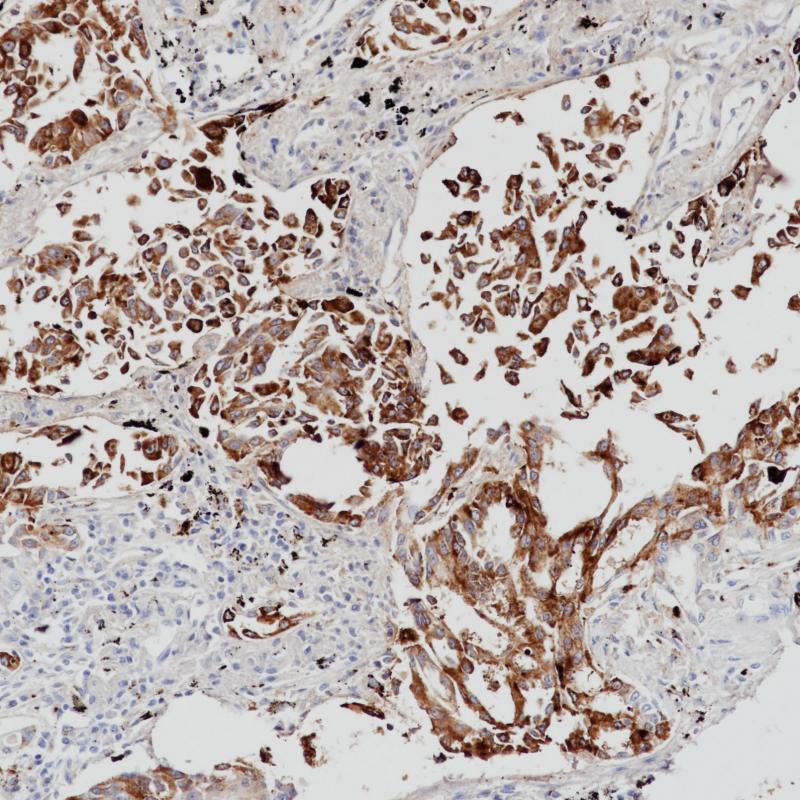 Lung adenocarcinoma