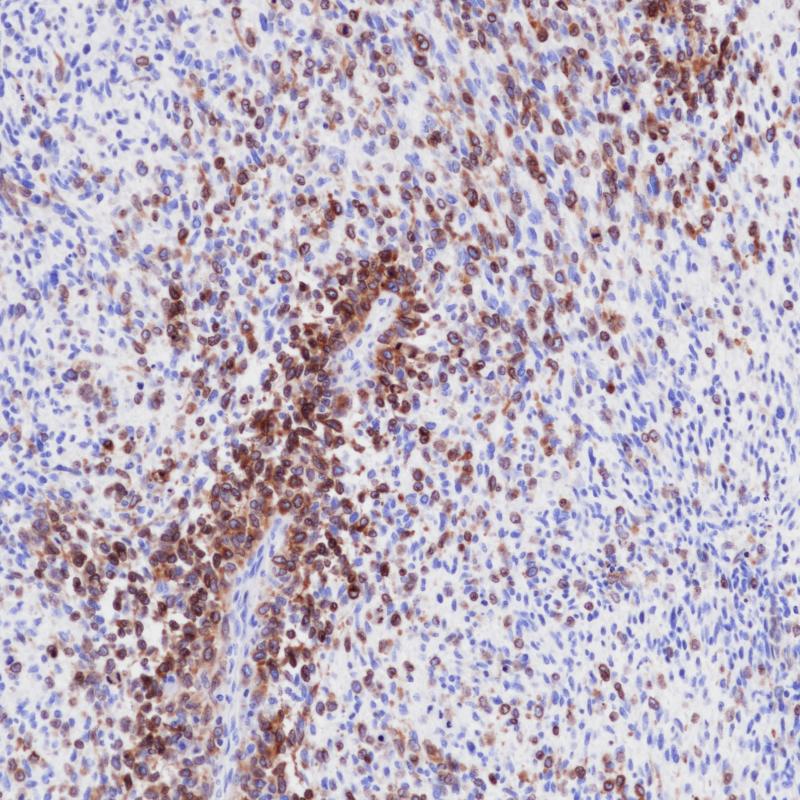 Malignant melanoma