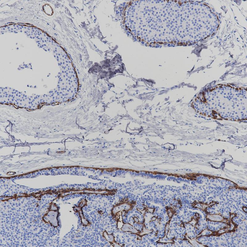 Breast Carcinoma 