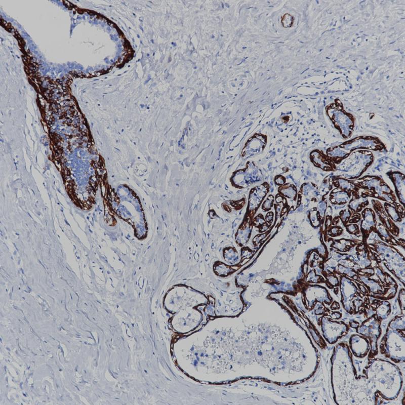 Breast Carcinoma