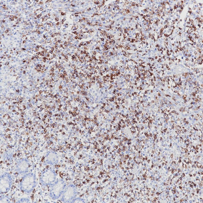 T Cell Lymphoma