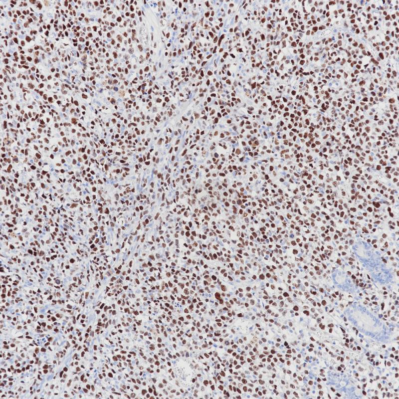 T Cell Lymphoma