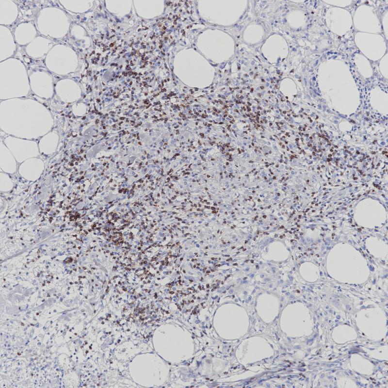 Panniculitis-like T-cell lymphoma