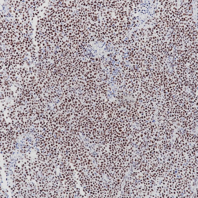 Diffuse Large B Cell Lymphoma