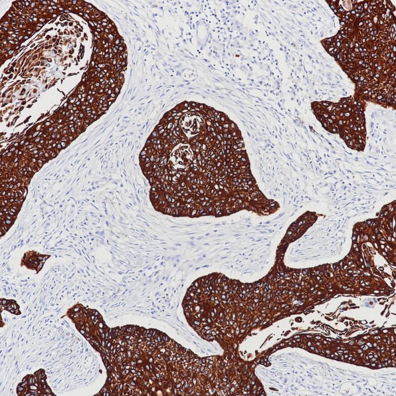 Lung Squamous Cell Carcinoma