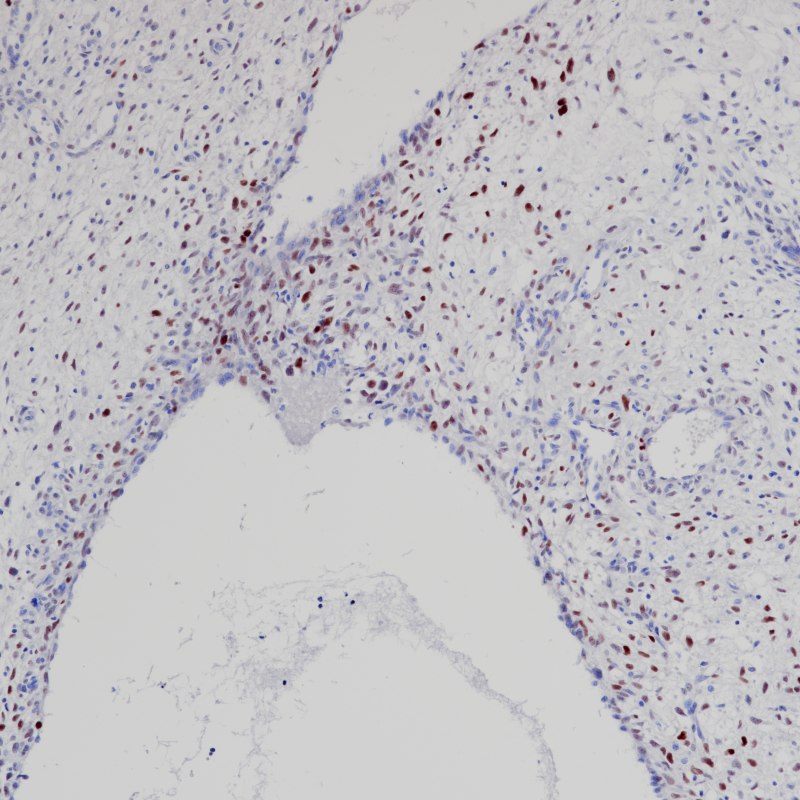 Dedifferentiated liposarcoma