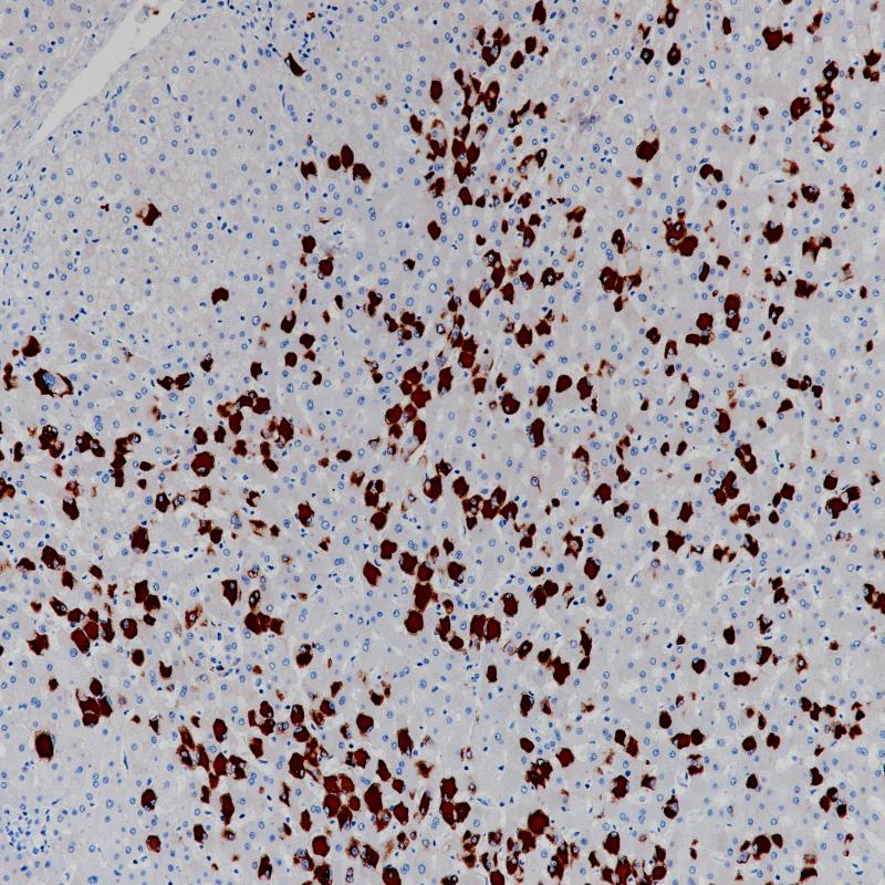 HBV infection of liver
