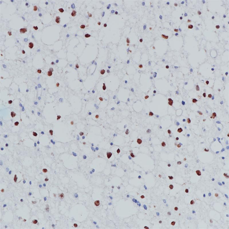 Oligodendroglioma